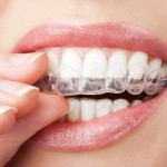 Invisalign being inserted by client